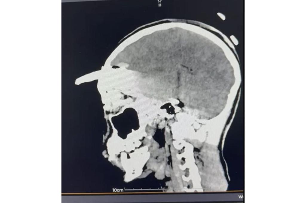 Adolescente sobrevive a compleja cirugía por machete curvo incrustado en su&nbsp;cráneo